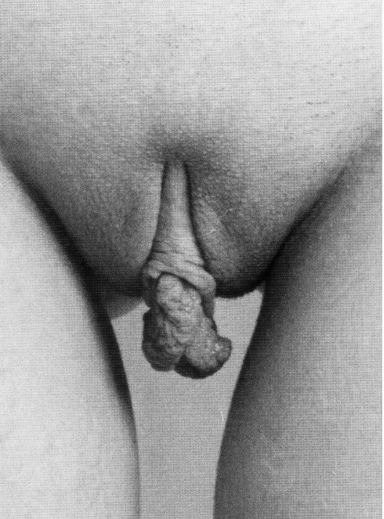 Vrouw Met Grote Schaamlippen Algemeen