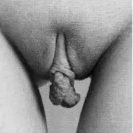 Vrouw Met Grote Schaamlippen
